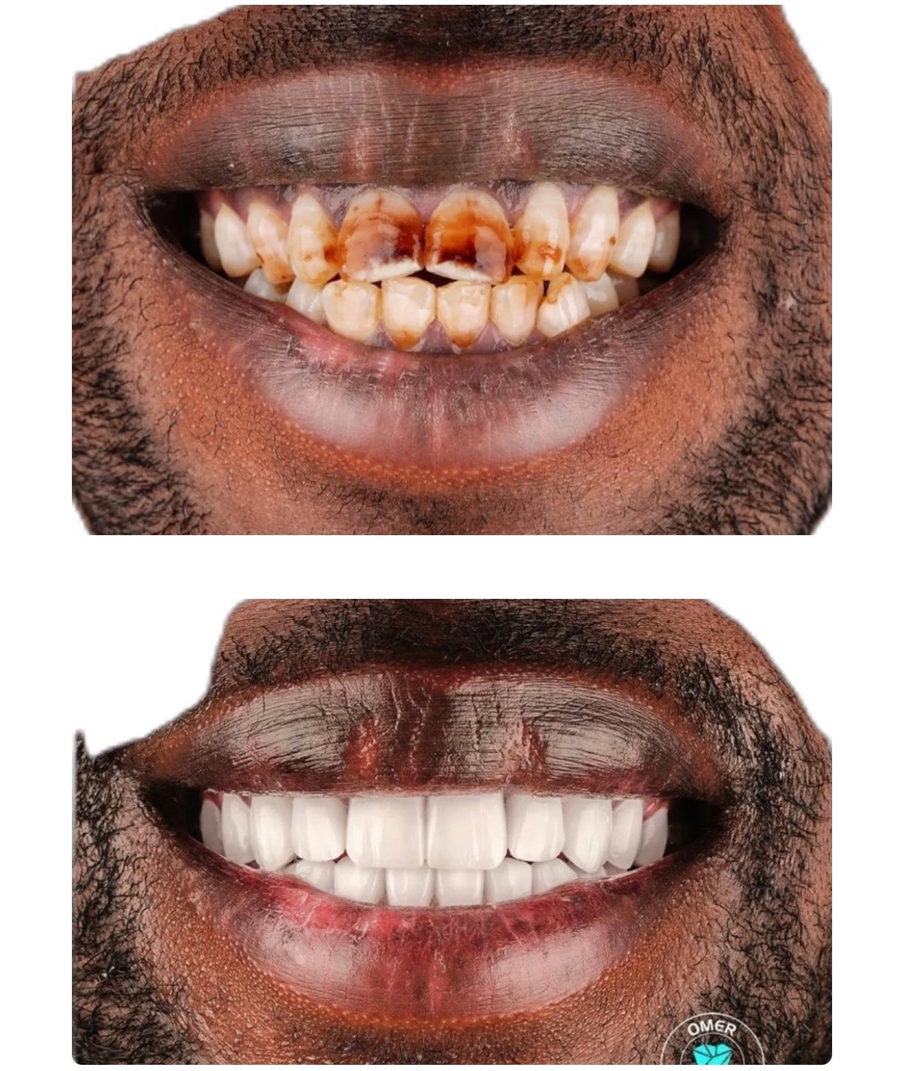 🦷 Dents plus blanches dès LES PREMIERS JOURS 🤩
